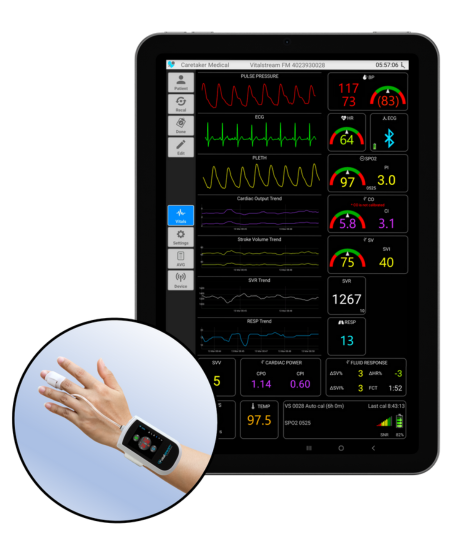 Wireless cardiac output monitor